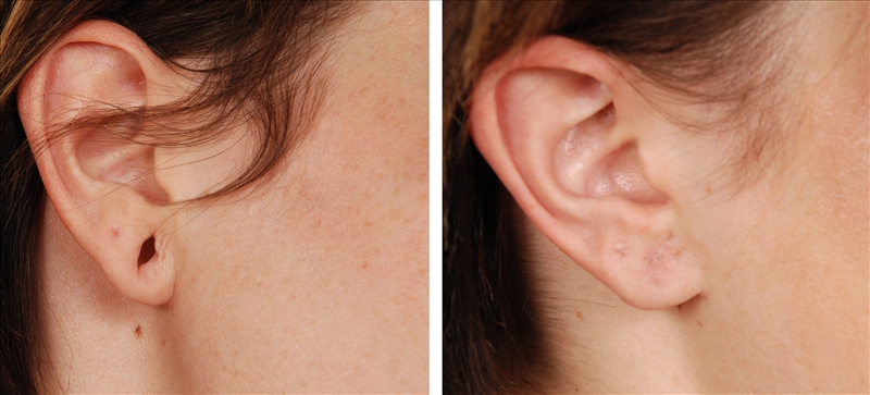 Ear Hole Repair  Best Ear Lobe Repair Specialist in Pune - Dr. Varsha  Rangari