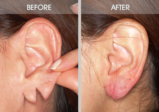 Ear Hole Repair  Best Ear Lobe Repair Specialist in Pune - Dr. Varsha  Rangari