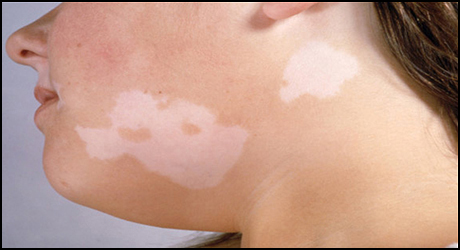 Vitiligo Treatment In Pune