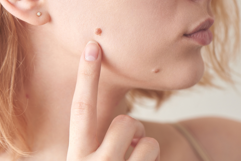 Get Mole Removal Treatment Cost in Pune