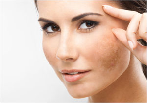 Get the best Melasma treatment at Earth & Ether Clinic