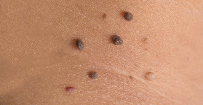 Skin Tag Removal Treatment